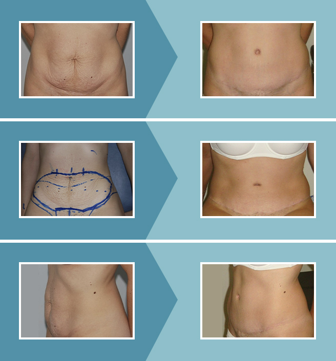 Preguntas frecuentes sobre la abdominoplastia o cirugia estetica del abdomen