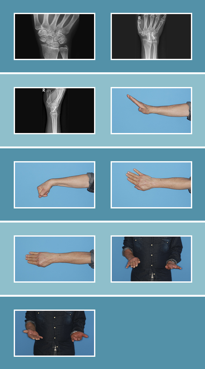 Artrosis de la mano y muñeca: síntomas y tratamiento. Clínica Universidad  de Navarra