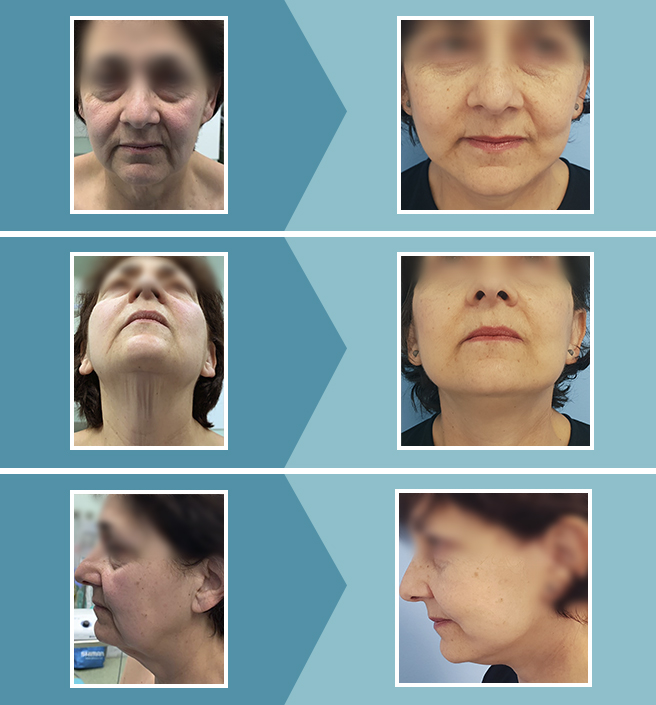 Antes y Después Lifting Facial [Fotos y Casos Reales]