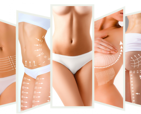 que-es-la-lipoabdominoplastia