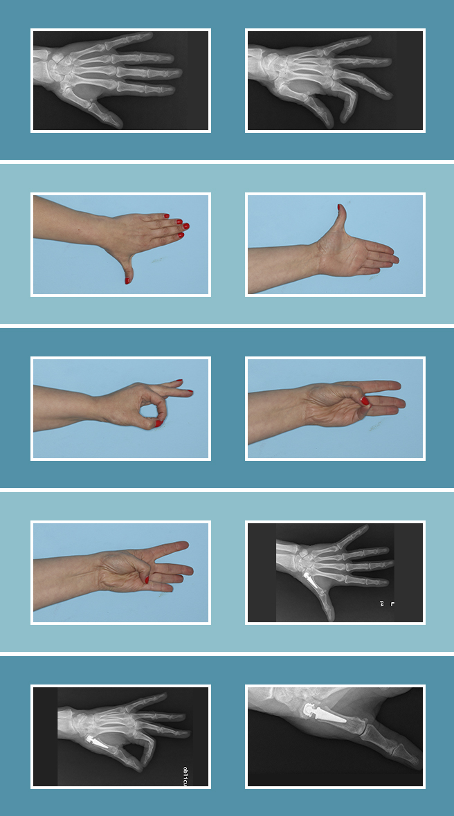Artrosis de mano: ¿Cómo detectarla? - Clínica Las Condes