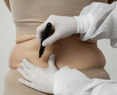 diferencia entre liposuccion y lipoescultura