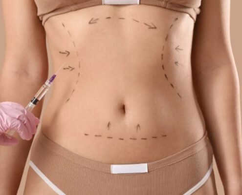 abdominoplastia