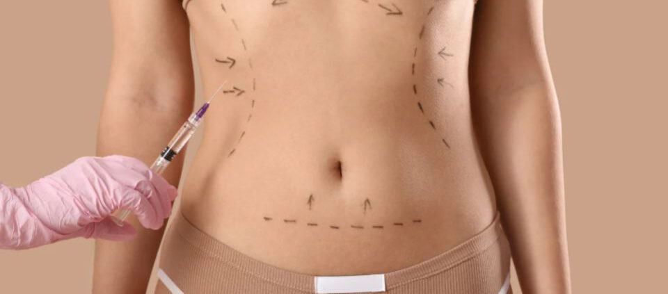 abdominoplastia