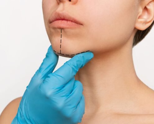 que es la mentoplastia