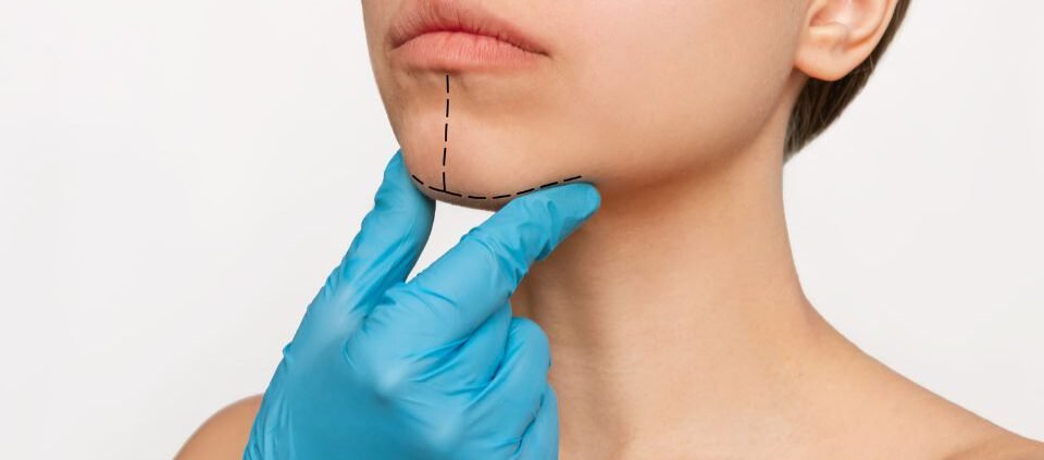 que es la mentoplastia