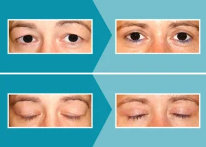 Caso real 1 blefaroplastia antes y después