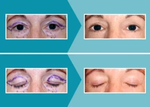 Caso real 2 blefaroplastia antes y después