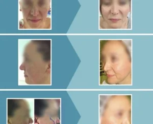 Caso real 1 lifting facial antes y después