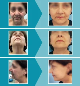 Caso real 2 lifting facial antes y después