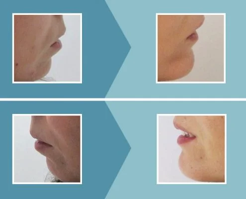 Caso real 2 mentoplastia antes y después