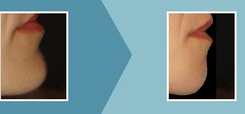 Caso real 3 mentoplastia antes y después