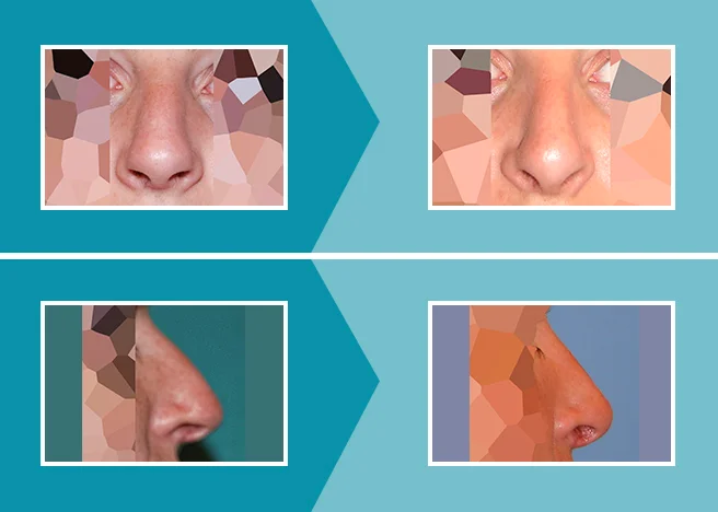 Caso real 1 rinoplastia antes y después