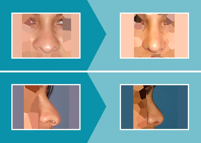 Caso real 2 rinoplastia antes y después